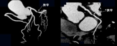 典型的な狭心症の症例