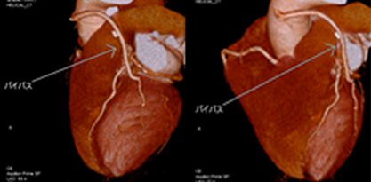 冠動脈バイパス術後の症例